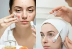 Easy way To Remove Pimples