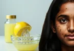 Remove Dark Spots Naturally with Lemon Juice in Hindi