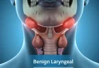 Benign Laryngeal Tumors