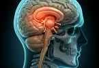 Olfactory Groove Meningioma