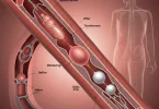 Percutaneous Transluminal Angioplasty (PTA) (1)