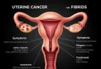 Uterine Cancer vs Fibroids