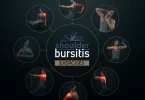 shoulder bursitis