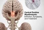 Central Pontine Myelinolysis