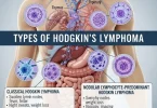 Hodgkin's Lymphoma