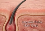 Ingrown Pubic Hair Cysts