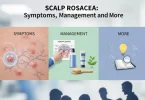 Scalp Rosacea