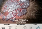 Scalp psoriasis
