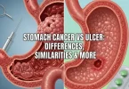 Stomach Cancer vs Stomach Ulcer
