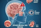 Untreated Bacterial Sinus Infection