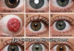image of eye cancer