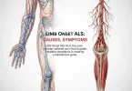 Limb Onset ALS