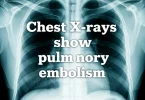 pulmonary embolism