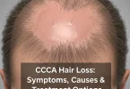 Central centrifugal cicatricial alopecia