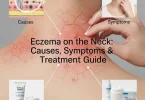 Eczema on the neck