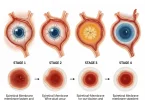 Epiretinal membrane stages