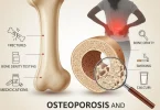 Osteoporosis and menopause