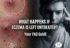eczema is left untreated