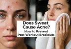 sweat cause acne