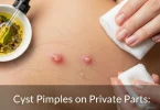Cyst Pimples