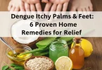 dengue itchy palms and feet home remedies