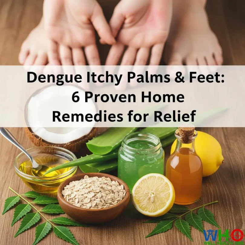 dengue itchy palms and feet home remedies