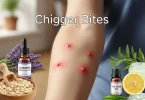 chigger bites