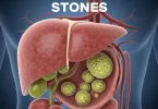 Gall Bladder Stones