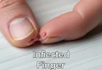 infected finger cuticle home remedy