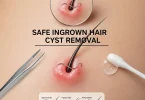 Safe Ingrown Hair Cyst Removal at Home