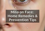 milia on face