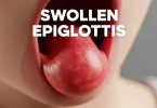 Swollen Epiglottis