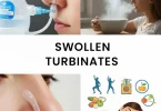 swollen turbinates home remedies