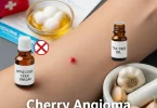 cherry angioma removal at home