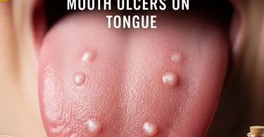 Tongue Ulcers
