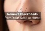 How to Remove Blackheads From Nose at Home