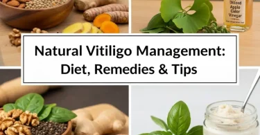 home remedies for vitiligo