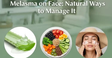 home remedies for melasma on face