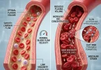 blood viscosity and clot risk
